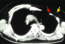 2年前の胸部単純CT横断面像