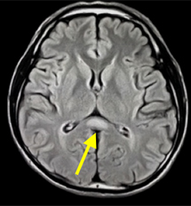 MRIのフレア横断面像