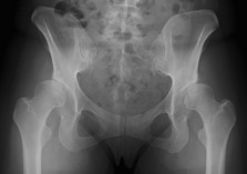 38歳女性、寛骨臼回転骨切り術術前