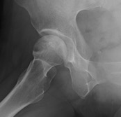 41歳女性、骨移植術術前