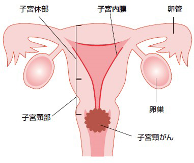 子宮頸がん