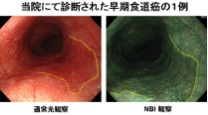 当院にて診断された早期食道癌の一例