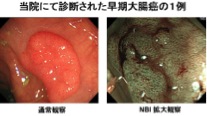 当院にて診断された早期大腸癌の一例