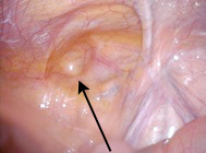 おなかの中から見た、鼡径ヘルニア