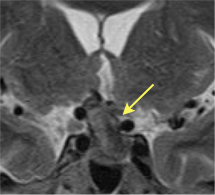 MRIのT2冠状断像
