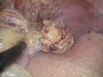 実際の外側区域腫瘍の部分切除