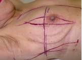 術後放射線照射中の乳房