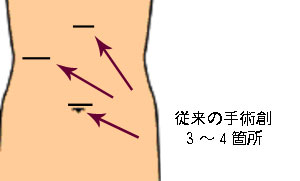 従来の手術創3〜4箇所