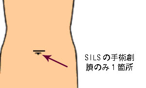 SILSの手術創臍のみ1箇所